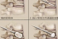 经皮椎体后凸成形术—治疗椎体压缩的首选