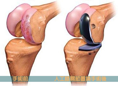 关节置换术