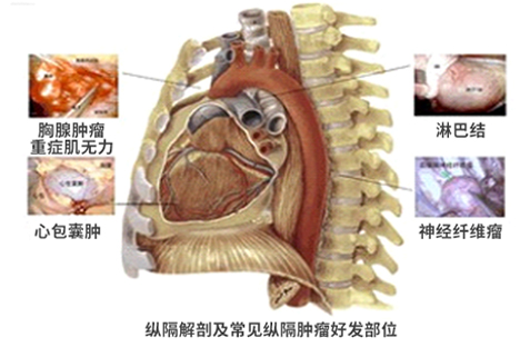 胸腔镜纵膈手术